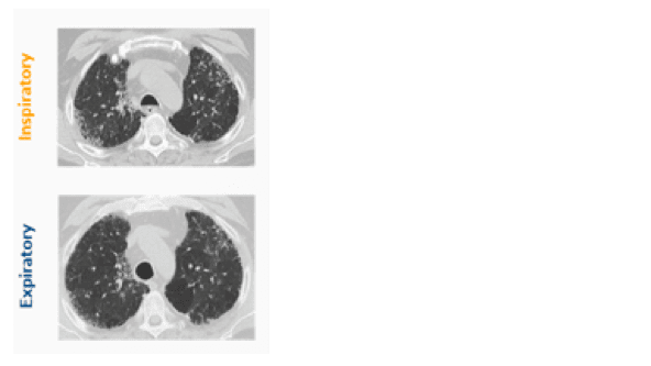 Een HRCT-scan bevestigt dat Robert longfibrose heeft: