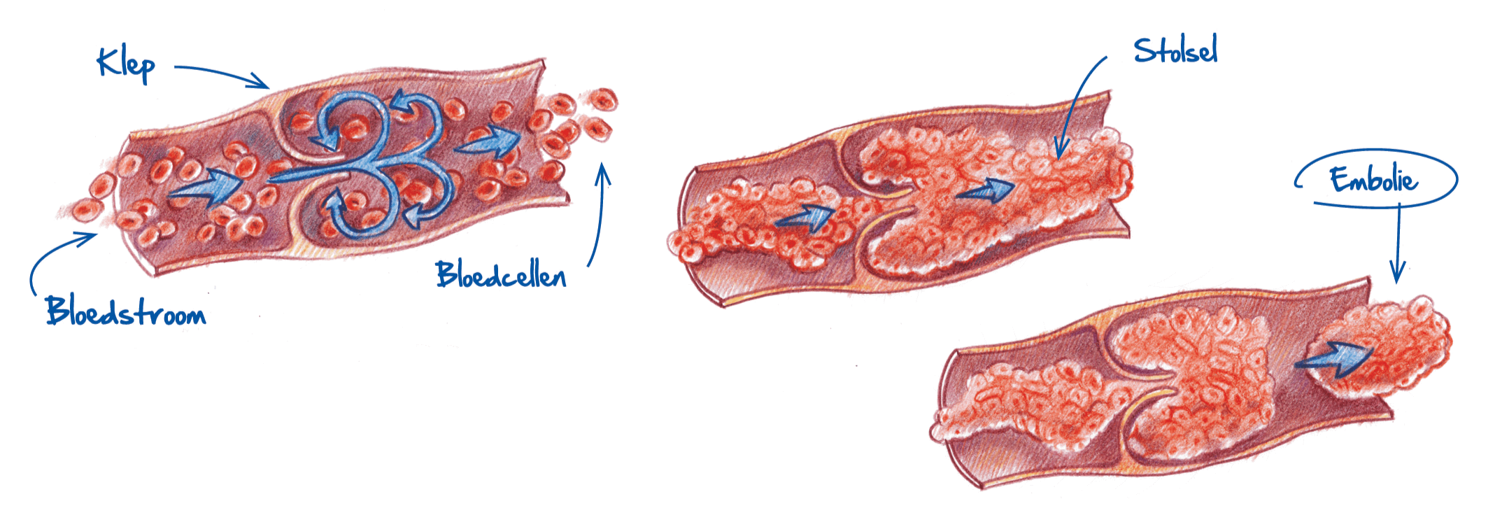 Verhoogd risico op trombose