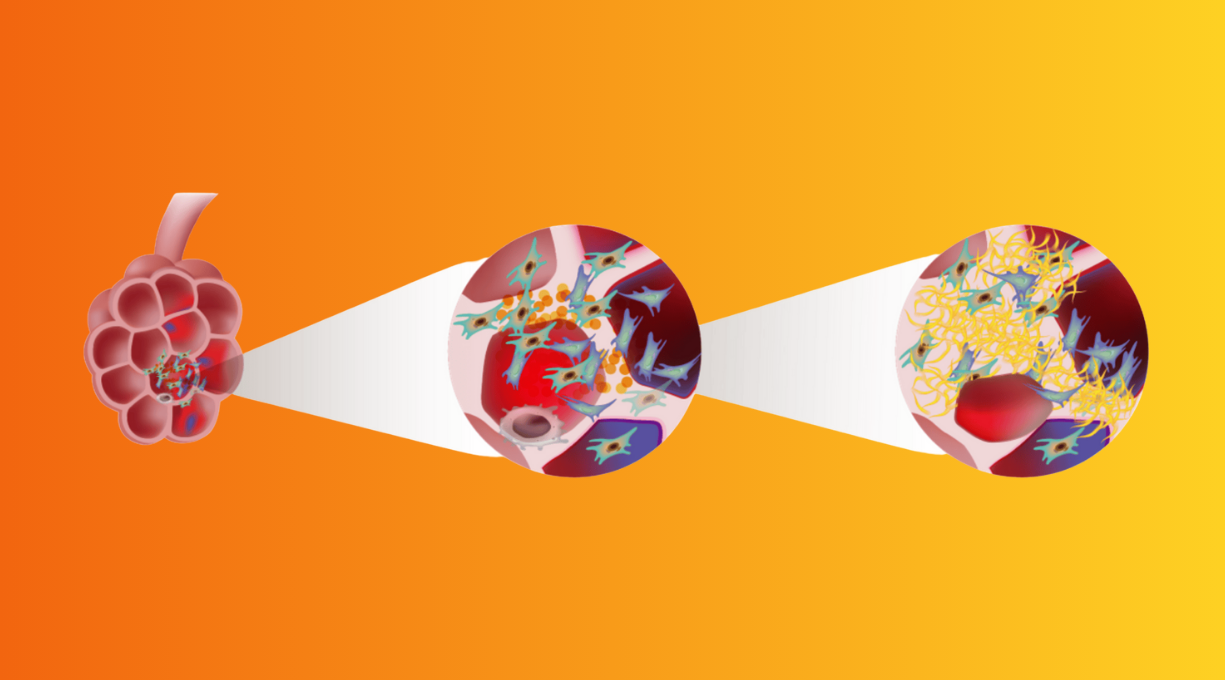 Ontstaan longfibrose