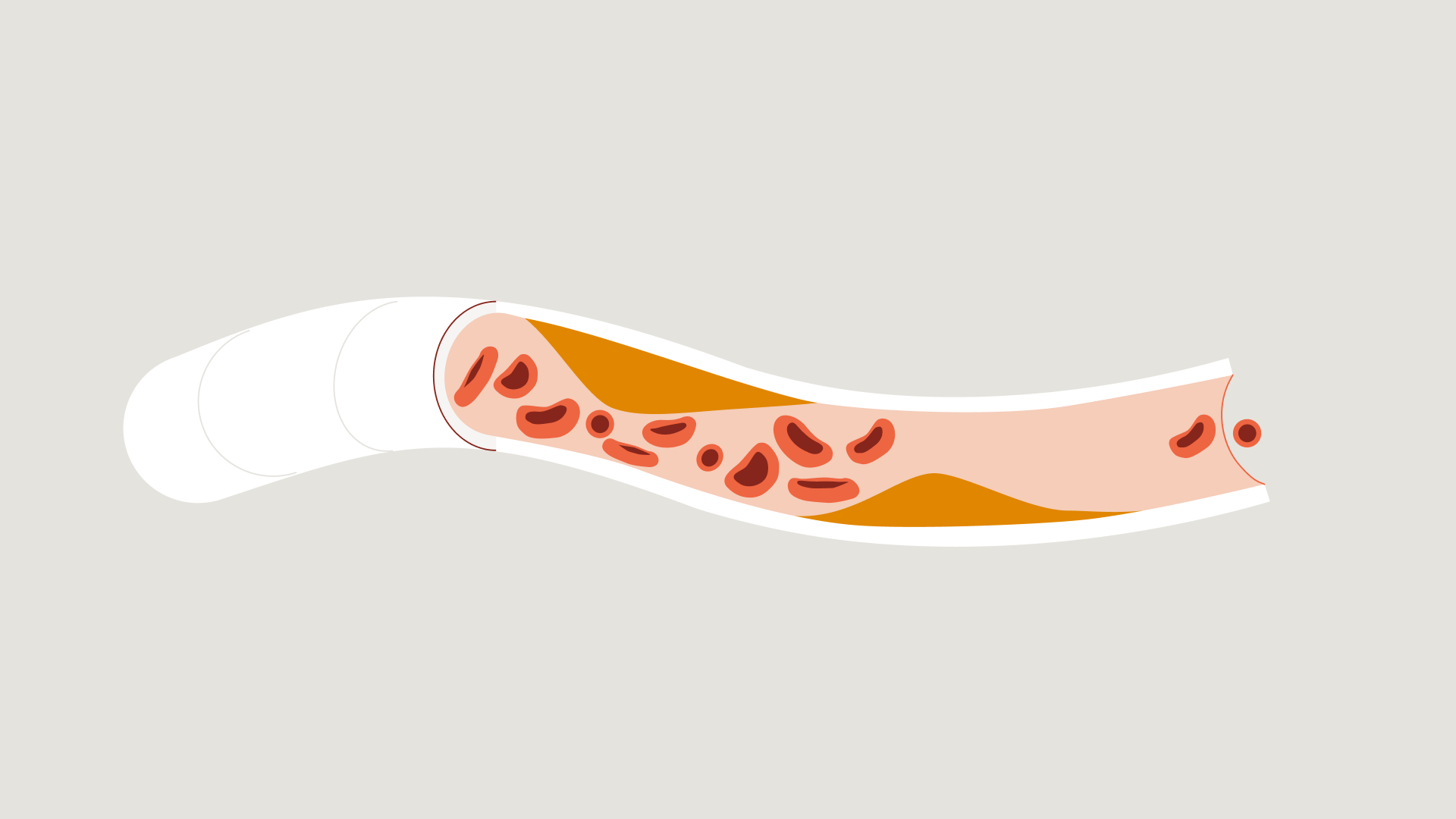 Wat is trombose en longembolie